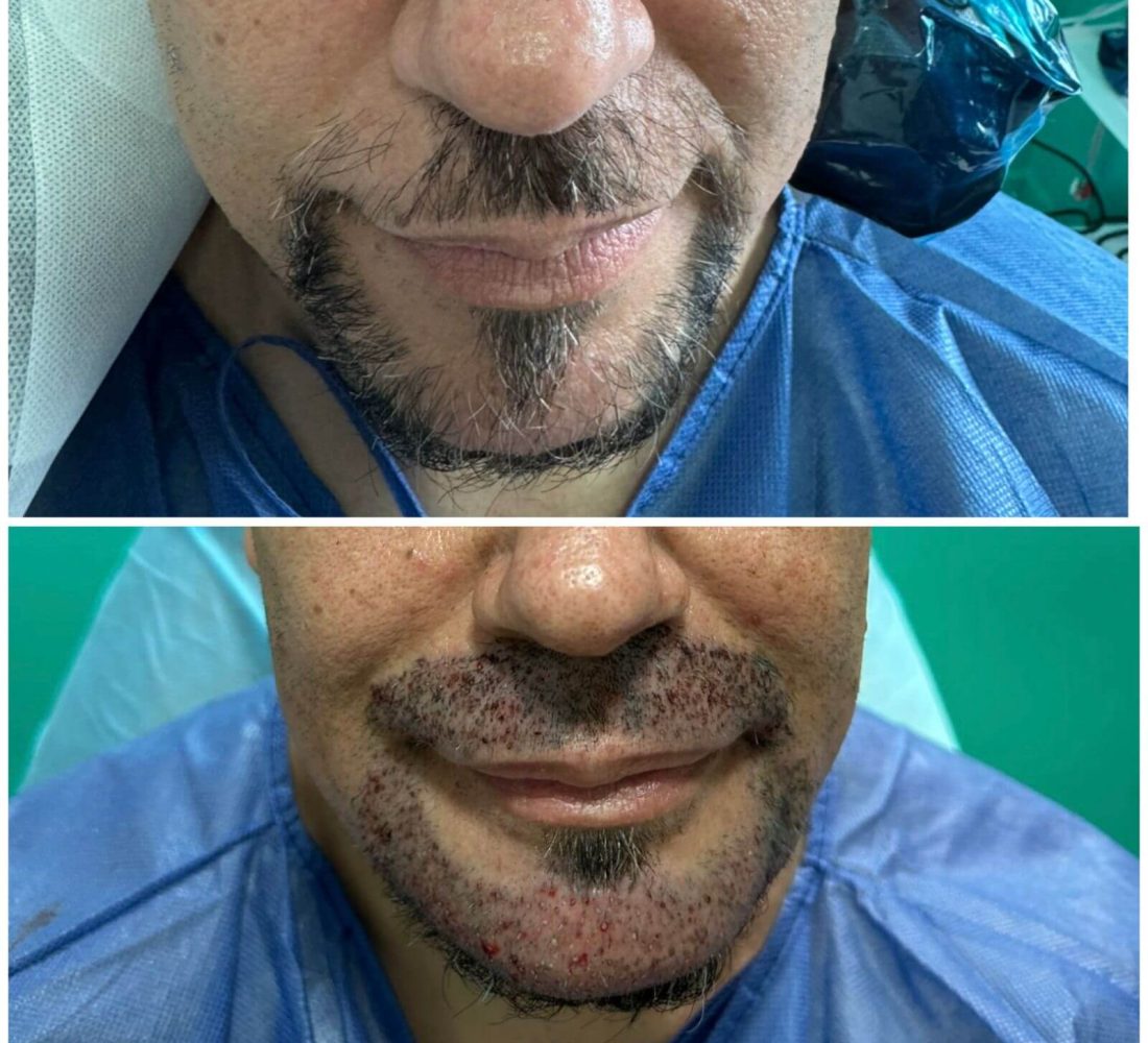 Barba y Bigote FUE