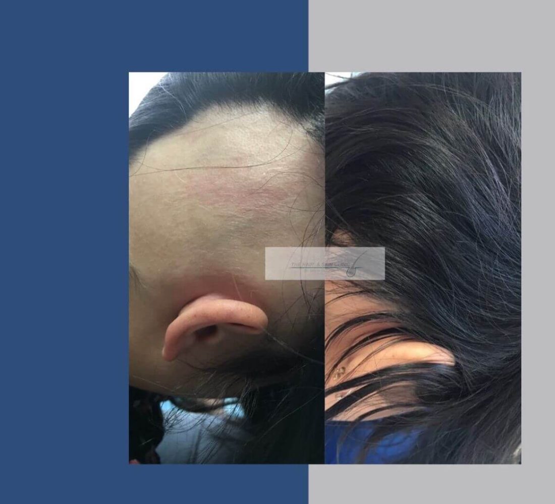 Cai╠üda de cabello 3