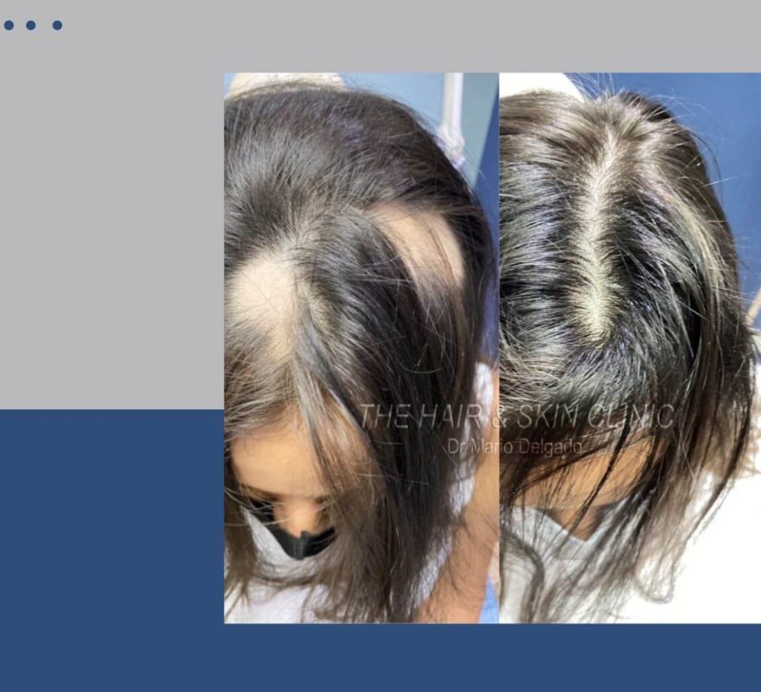 Cai╠üda de cabello 4