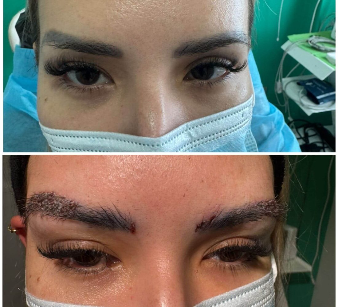 Cejas FUE largo 1