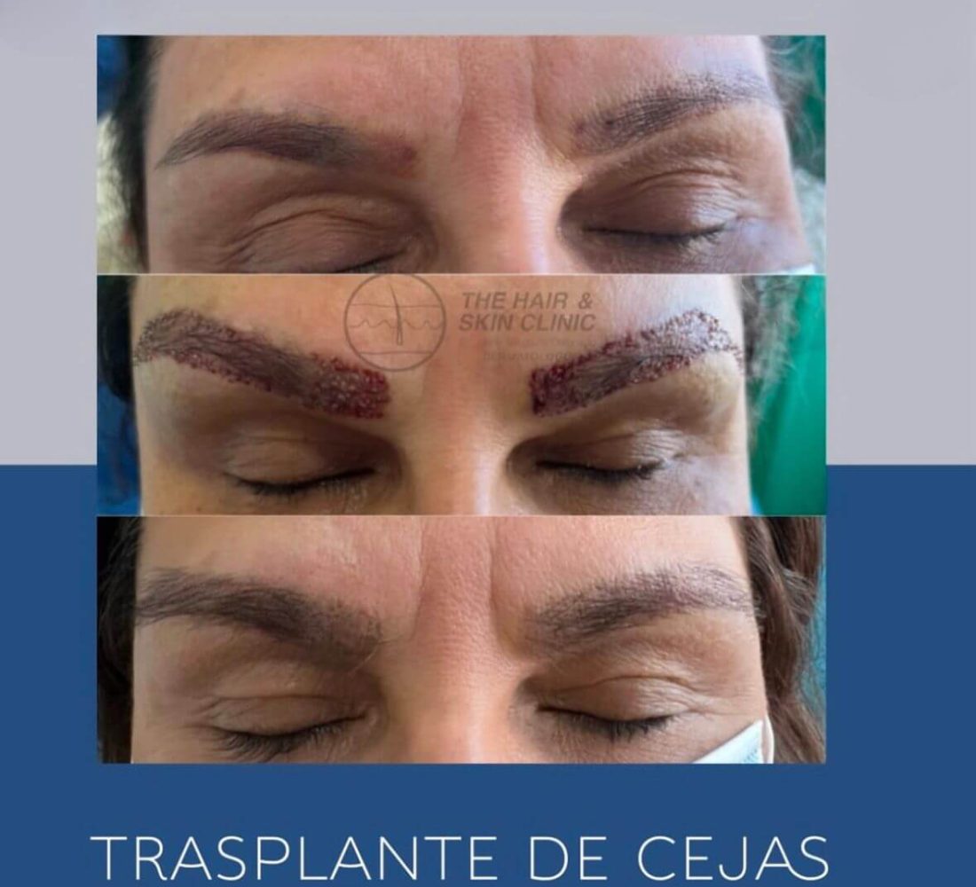 Cejas FUE medio 1