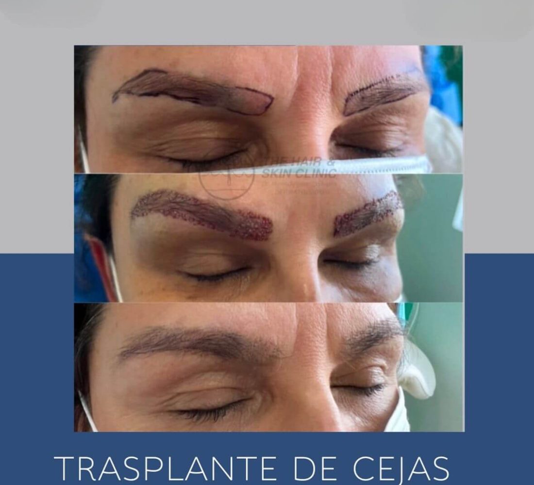 Cejas FUE medio 2
